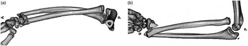 Figure 2. Anteroposterior (a) and lateral (b) views of reconstructed three-dimensional computed tomography (CT) of the right forearm. Anteroposterior and lateral directions of the forearm were adjusted according to the elbow joint orientation in this CT and later radiographs.