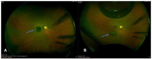 Figure 9 Optos color photo.