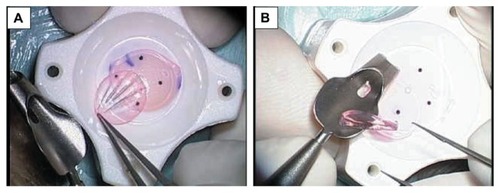 Figure 1 Problems that occur during donor-endothelial lamella loading onto a Busin glide. (A) Wrinkling of the donor lamella; (B) Folding of the donor lamella.