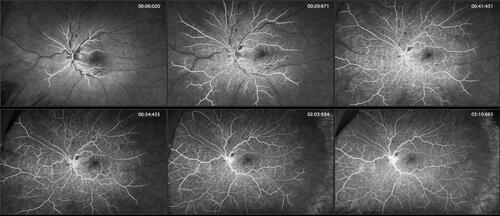 Figure 2 FA studies demonstrate delayed central retinal vein filling in the left eye. While the central retinal arteries began filling 6 seconds after the fluorescein dye injection was complete (approximately 16 seconds after the injection was initiated), complete filling of the peripheral branches of the central retinal artery progressed but was never complete even by the end of the angiogram (4 minutes and 30 seconds – not shown).