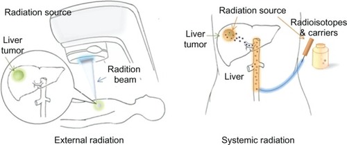 Figure 1 External radiation therapy and systemic radiation therapy.