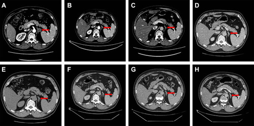 Figure 3 Abdominal CT scan of the metastatic tumor in left adrenal gland before and during the treatment course. (A) Metastatic tumor in left adrenal gland before the treatment of nivolumab (Red arrow). (B) Metastatic tumor in left adrenal gland after 4 cycles treatment of nivolumab (Red arrow); (C) Metastatic tumor in left adrenal gland after 8 cycles treatment of nivolumab (Red arrow); (D) Metastatic tumor in left adrenal gland after 12 cycles treatment of nivolumab (Red arrow); (E) Metastatic tumor in left adrenal gland after 15 cycles treatment of nivolumab (Red arrow); (F) Metastatic tumor in left adrenal gland after 3 months since the drug withdrawal (Red arrow); (G) Metastatic tumor in left adrenal gland after 7 months since the drug withdrawal (Red arrow); (H) Metastatic tumor in left adrenal gland after 12 months since the drug withdrawal (Red arrow).
