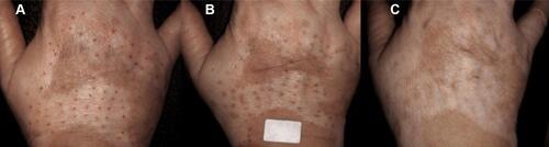 Figure 5 Loss of graft pigment due to lesional activity. (A) Baseline right-hand dorsum vitiligo lesion. (B) Perigraft pigmentation with good marginal definition at 12 weeks after mini-punch grafts followed by needling sessions. (C) Loss of pigmentation at and around the implanted grafts at 18 weeks indicating activity.