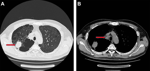 Figure 1 The CT scan of the patients before surgery. (A) The 4 cm tumor on the right upper lobe (Red arrow); (B) Metastatic right No.4 lymph node (Red arrow).