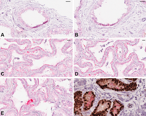 Figure 4 Immunolocalization of omentin-1/ITLN1 in epididymis and seminal vesicles (Ultraview Universal Alkaline Phosphatase Red Detection Kit, Ventana). In epididymis (A and B) the immunostaining is present in the basal area of epididymal tubule. Seminal vesicle epithelium (C–F) shows a diffuse signal (C and D) located in the cytoplasm of columnar cells (E). (F) shows a double immunostaining with PAX8 (nuclear marker of seminal vesicle epithelium) located in the nuclei (brown) and omentin-1/ITLN1 located in the cytoplasm (pink/red). Bars: A, B: 50 µm; C, D:100 µm; E: 10µm; F: 6 µm.