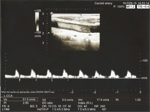 Figure 3 A Doppler ultrasound image of a 76-year-old female. There was an evident calcified carotid atheroma (Group A, study group).