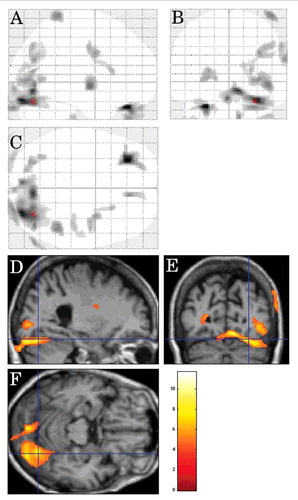 FIGURE 3. Inter-CJD SPM analysis showing decreased metabolism (using a stringent level of significance of p<0.001 and an extent threshold of 100 voxels) in the bilateral (right-predomiant) occipital cortex and the right frontal subcortical lobe in CJD patients with visual signs.