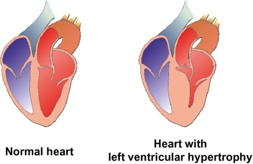 Figure 2 Morphological features of a normal heart and a heart with left ventricular hypertrophy.