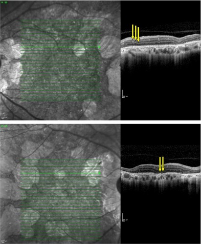Figure 2 Spectral domain optical coherence tomography images of both eyes through the retinal crystals.