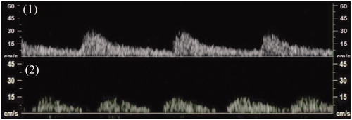 Figure 4. Changes in velocity of blood flow before (1) and after (2) injecting a dilute vasopressin solution determined based on the pulsation of the space between the myometrium and surface of the leiomyoma. PI on blood flow in the space changed from 0.94 to 1.40.