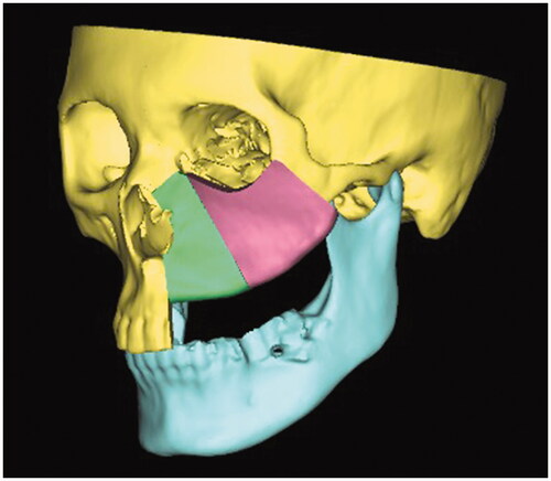 Figure 2. Virtual reconstruction with iliac crest.