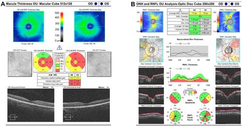 Figure 2 Optical coherence tomography (OCT) exams. (A) OCT of ganglion Cells OU analysis showing reduction of the macular ganglion cells especially in the temporal quadrants. (B) OCT of retinal fiber thickness (RNFL) examination (OCT, Cirrus Zeiss) showing a reduction of the thickness of the nerve fiber layer.