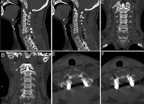 Figure 6 Postoperative CT. (A and B) Sagittal CT image; (C and D) Coronal CT image; (E) C6 upper edge of the vertebral body axial CT image; (F) Lower edge of the C6 vertebral body axial CT image.