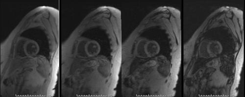 Figure 1 MRI 1.5 T (Siemens Avanto), using multi-TE gradient echo T2* MRI technique. Heart intensity is normal seen with the longest TE (14.68 msec). T2* =29.4 ms corresponding to <1.2 mg Iron/ g heart dry weight.