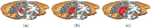 Figure 9. Growth of LGG in the MRI T1 data.(a) T=20. (b) T=60. (c) T=80.