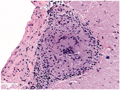 Figure 4. Typical sarcoid granuloma in the subarachnoid space of the cerebellum (H&E stain, original magnification ×200): multinucleated giant cells and clusters of epithelioid histiocytes surrounded by lymphocytes expand the subarachnoid space. Underlying cerebellar parenchyma is gliotic.