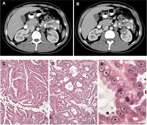 Figure 2 (A–E) Clinical manifestations of hereditary leiomyomatosis and renal cell carcinoma (HLRCC): renal tumors.