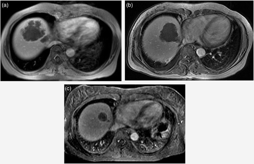 Figure 4. A 50-year-old woman with multiple hepatic metastasis from stomach carcinoma. Initial contrast-enhanced axial T1-weighted MR image shows one of multiple metastatic nodules in both lobes of the liver (a). Follow-up T1-weighted image two weeks after HIFU shows complete coagulative necrosis of the lesions (b). Although further follow up 107 days after HIFU shows progression of new lesions at non-ablated portions of the liver, no recurrence was seen at the ablated sites and decrease in size of the ablated sites are seen (c).