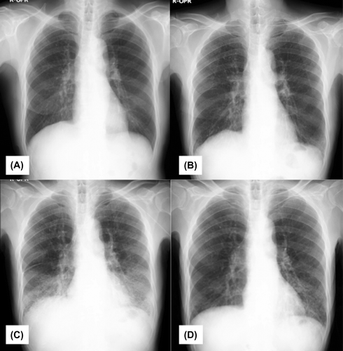 Figure 2. IP progression observed on chest X-rays. (A) Baseline Chest X-ray before the treatment. (B) On Day 42, a chest X-ray shows decreased radiolucency in both lower lung fields. (C) On day 55, a chest X-ray shows worsened bilateral, progressive infiltration. (D) Chest X-rays after treatment with prednisone show significant improvement.