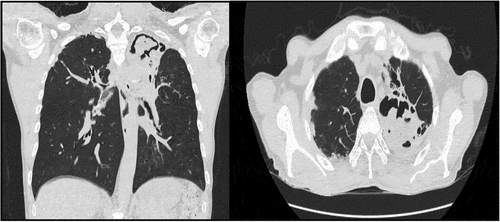 Figure 3. Chest CT scan, evidence of a cavity with content compatible with mycetoma, and multiple bronchiectasis in S1 and 2.