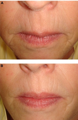 Figure 2 A 55-year-old woman with thin lips and perioral fine lines and elongation of the philtrum.