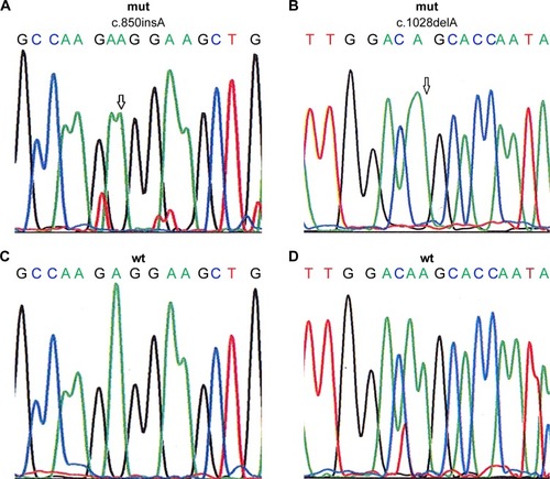 Figure 1 Sequencing chromatograms show two mutations in TRβ1 gene (c.850insA in exon 7 and c.1028delA in exon 8, marked by arrows) and corresponding wild-type sequences.