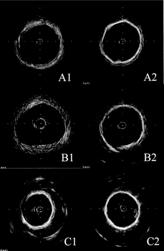 Figure 15 IVUS illustrations of the lumen and the cross-section of the explanted stent-graft: A1, A2) representative specimen of 18 devices whose capsule was discrete of absent; B1, B2) representative specimen of 7 devices whose thickness of the internal capsule was variable; C1, C2); representative specimen of 4 devices whose luminal surface was scattered with mural thrombi.