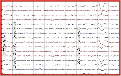 Figure 4: EEG at 9 months post treatment (July 2007) showing significant improvement in the EEG with a normal background without periodic complexes.