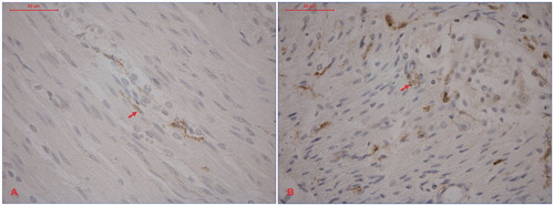 Figure 2. Immunohistochemic analyses of gastric antrum wall autopsy specimens visualizing TMEM16A-IR ICC (dark brown) in (A) a patient with hereditary TTR amyloidosis and (B) A non-amyloidosis control. A ×40 objective (40×/0.70, Pl Fluotar, Leica) was used for the analyses.
