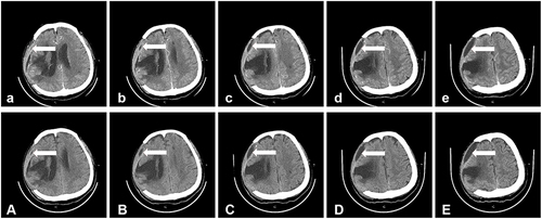 Figure 1 Brain CT plain scan results. Postoperative reexamination of intracerebral hemorrhage in the thalamus and Corona radiata areas in the right basal ganglia region revealed meningoencephalitis in the right cerebral hemisphere, and a small amount of subdural/extradural effusion in the operative area (arrow). Multiple softening foci in the brain, roughly the same as before (a-e). A contrast-enhanced brain CT on August 18 revealed a small amount of fluid within the subdural space adjacent to the right frontal lobe. An enhanced scan showed mild to moderate enhancement. There was a strip-like low-density shadow in the operative area of the right brain and a softening lesion in the right vertebral temporal lobe, which was partially connected with the adjacent ventricle. Small patches of low-density shadow were observed in bilateral basal ganglia, right midbrain, and left Corona radiate, and some edges were blurred.(A–E) No obvious abnormal enhanced shadow was observed on the enhanced scan.