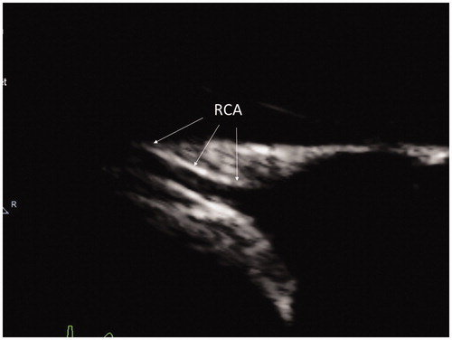 Figure 2. Standard parasternal short axis view: coronary arteries appear as linear intramyocardial fragmental structures. RCA: right coronary artery.