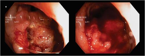 Figure 1 Colonoscopy findings. We found easily bleed mass at approximately 15 cm from the anal valve covering the intestinal lumen.