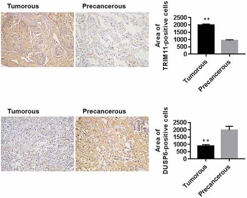 Figure 1. Expression of TRIM11 and DUSP6 in the lung tissue of patients with NSCLC, assessed by IHC assay. Ten cases of tumorous and precancerous lung tissues were analyzed. The representative images and the quantification of positive staining are shown. Magnification: ×200. **P < .01 vs. precancerous lung tissue