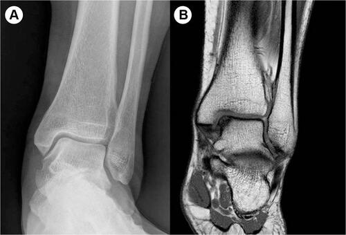 Figure 3 (A and B) Osteochondral lesion difficult to be diagnosed in preoperative radiographic examination.