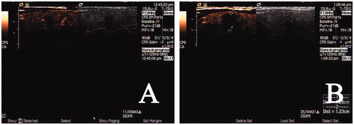 Figure 3. Preoperative imaging and CEUS imaging immediately after RFA. (A) Preoperative CEUS imaging showing the hypoechoic nodule was low-enhanced; (B) CEUS imaging immediately after RFA revealed a non-enhanced area of 1.6 cm × 1.4 cm ×1.2 cm in the ablated area.