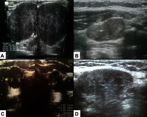 Figure 1 Lymph node metastases/recurrences of the aggressive forms of well-differentiated thyroid cancers. (A) 48-year-old woman with metastases of papillary thyroid cancer to the left neck lymph nodes. (B) 69-year-old woman with neck lymph node recurrence of follicular thyroid cancer 1 year after thyroidectomy. (C) 84-year-old woman with metastases of follicular thyroid carcinoma to the lymph nodes and lung. (D) 54-year-old man with papillary thyroid cancer and metastases to the lymph nodes and infiltration of the trachea and recurrent laryngeal nerve.