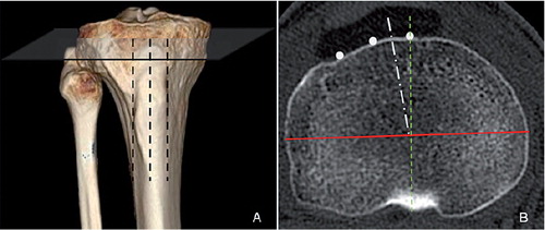 Figure 1. A. 3-D CT scan showing detection of the medial and lateral border and the middle of the tibial tuberosity (TT) and the level at which the proximal AP tibial axes were identified. B. Axial CT scan illustrating the projection of the TT (filled circles) and of the femoral transepiconylar axis (FTA) (red line). The white dash-dot line represents AP axis 1, connecting the middle of the FTA with the medial one-third of the TT. The green dotted line represents AP axis 2, connecting the posterior tibial notch with the medial border of the TT (Akagi line).