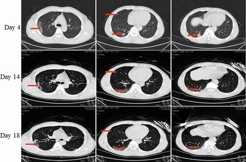 Figure 4. Chest CT scans on days 4, 14, and 18 after onset for Pt-2. CT showed scattered bilateral multiple high-density effusions, faintly exudative shadows along the lungs on day 4. Effusions were absorbed and partially fibrotic on day 14. Obvious absorption was observed on day 18. Red arrows indicate typical lesions.