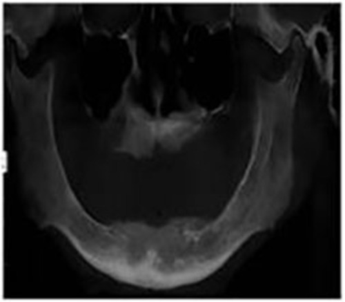 Figure 5 DVT-CI=3, cortical bone, which is apparent porosal, and seen in many resorbent cavities.