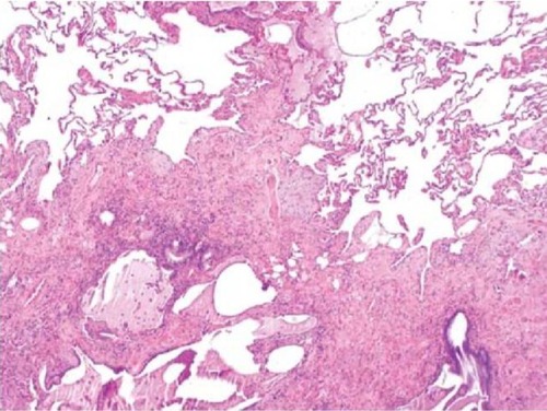 Figure 2 Surgical lung biopsy specimen demonstrating usual interstitial pneumonia pattern, characterized by the abrupt transition from fibrotic tissue with honeycombing and few pale fibroblastic foci (bottom) to nearly normal lung (top).
