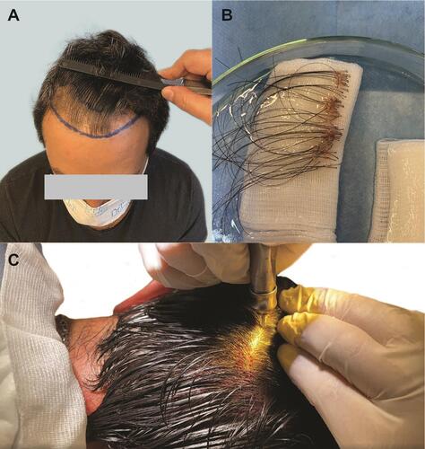 Figure 14 Case 3, a 33-year-old Caucasian male who requested non-shaven FUE with long hair to prevent obvious post-surgical scabbing and wanted to preview what the recipient area might look like with the final growth. The all-purpose FUE device extracted 3289 grafts in a 2.5-h period, with 90% long hair retrieval and a 3–4% graft attrition rate. (A) The frontal area before grafting; (B) long-hair grafts; and (C) hand piece alignment at 90 degrees obviates the need to guess the hair exit angle.