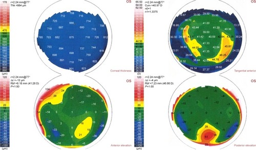 Figure 2 Corneal topography shows thickening of the cornea due to flap edema and interface fluid.