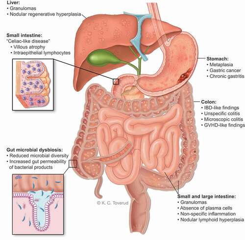 Figure 3. Macroscopic and microscopic gastrointestinal pathology and gut microbial dysbiosis in CVID. Gastrointestinal disease in CVID is associated with immune dysregulation, immunodeficiency and autoimmunity that effects the stomach, liver and large- and small intestine. The gut microbial composition in CVID is unhealthy and together with GI inflammation it allows gut leakage of microbial products into the blood stream to initiate/maintain an inflammatory process.