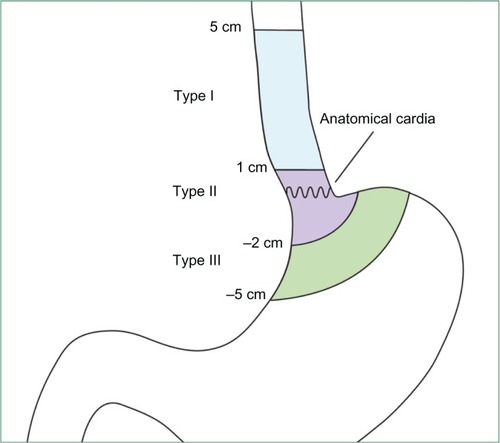 Figure 1 Schematic illustration of the modified Siewert’s classification. Reprinted from Mariette C, Piessen G, Briez N, Gronnier C, Triboulet JP. Oesophagogastric junction adenocarcinoma: which therapeutic approach? Lancet Oncol. 2011;12(3): 296–305.Citation61 With permission from Elsevier.