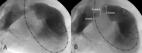 Figure 2. Angiograms of a control conduit at 3 months post-implant. There is severe obstruction of the pulmonary outflow at the interposition graft insertion site with the conduit diameter measuring approximately 9 mm.