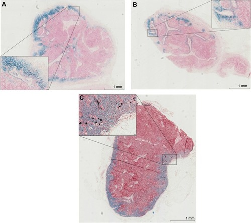 Figure 5 Iron distribution within nodes on histopathology using Perl’s Prussian blue staining for iron and haematoxyline & eosine.Notes: Magnification 2×, with inserts at 20× magnification. (A) Node containing the 111-nm tracer; (B) node containing the 59 nm tracer; (C) node containing the 32 nm tracer.