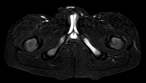Figure 5. T2-weighted MRI scan with a left-sided VND suspicious of osteomyelitis in a 7-year-old male patient.