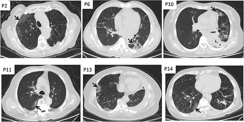 Figure 2 Sub-pleural pattern. Non-contrast chest CT scan showing multiple ground glass opacities with a predominant sub-pleural distribution in both lungs (Black arrow).