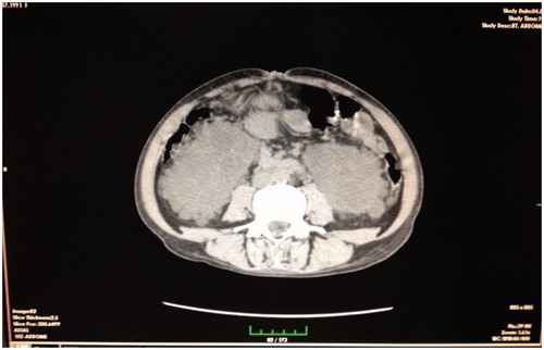 Figure 2. Non-contrast mediated abdominal CT, renal dimensions increased (15 and 16 cm), and multiple cysts were present in bilateral kidneys.