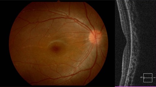 Figure 1 Preoperative right fundus and OCT imaging in Case 1.